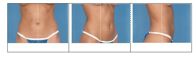 Abdomen Patient Preparation: Remove gown completely. Patient should wear paper panties. The front portion of the underwear must be below the treatment area.