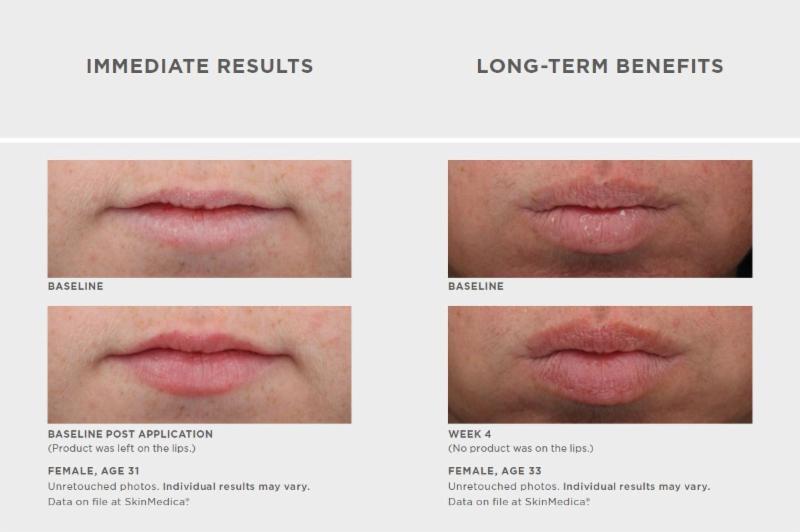 (rosiness), overall lip definition, and contour. But, unlike facial skin, your lips do not contain oil glands that help prevent the fine lines associated with signs of aging. But don't fret!