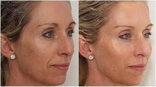 Vampire Face Lift from 85 RRS HA Tensor Lift is specially used as a filling of superficial wrinkles and a dermal anti ageing bio revitalisation.