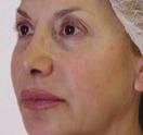 Collagen Thread Lifting The Lunch Hour Face Lift 399 This treatment offers its patients an opportunity to help keep ageing at bay with a discreet anti-ageing