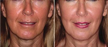 Collagen Induction Therapies Mesotherapy with Mask 75 with Derma Plaining 90 with Skin Peel 110 Mesotherapy Full Face 100 Mesotherapy Hands 40 Mesotherpy Décolletage 80 Mesotherapy is a non surgical