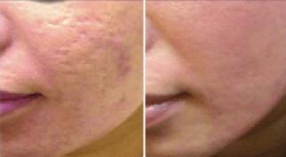 Collagen Induction Therapies Dermaplaning with Mask 45 with Growth Factors Collagen Serum & Mask 65 with Skin Peel & Mask 80 This is a very effective exfoliation procedure that can be performed
