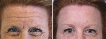 Botulinum (Botox) & Dermal Fillers Forehead Lines/Creases from 130 Botox used for the wrinkles and fine