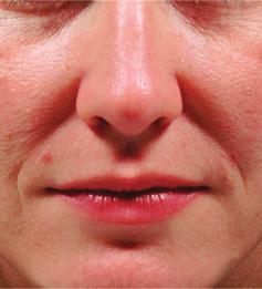 Botulinum (Botox) & Dermal Fillers Nasolabial line from 180 Fillers for the Nasal Labial folds are a great way to treat lines around the nose