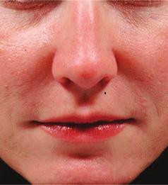The procedure uses dermal fillers to fill in the crease and plump the skin to give you a more youthful appearance.