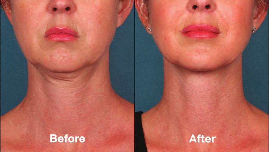 Dermal fillers are an effective treatment for marionette lines; they can thicken the skin and reduce the appearance of the lines.