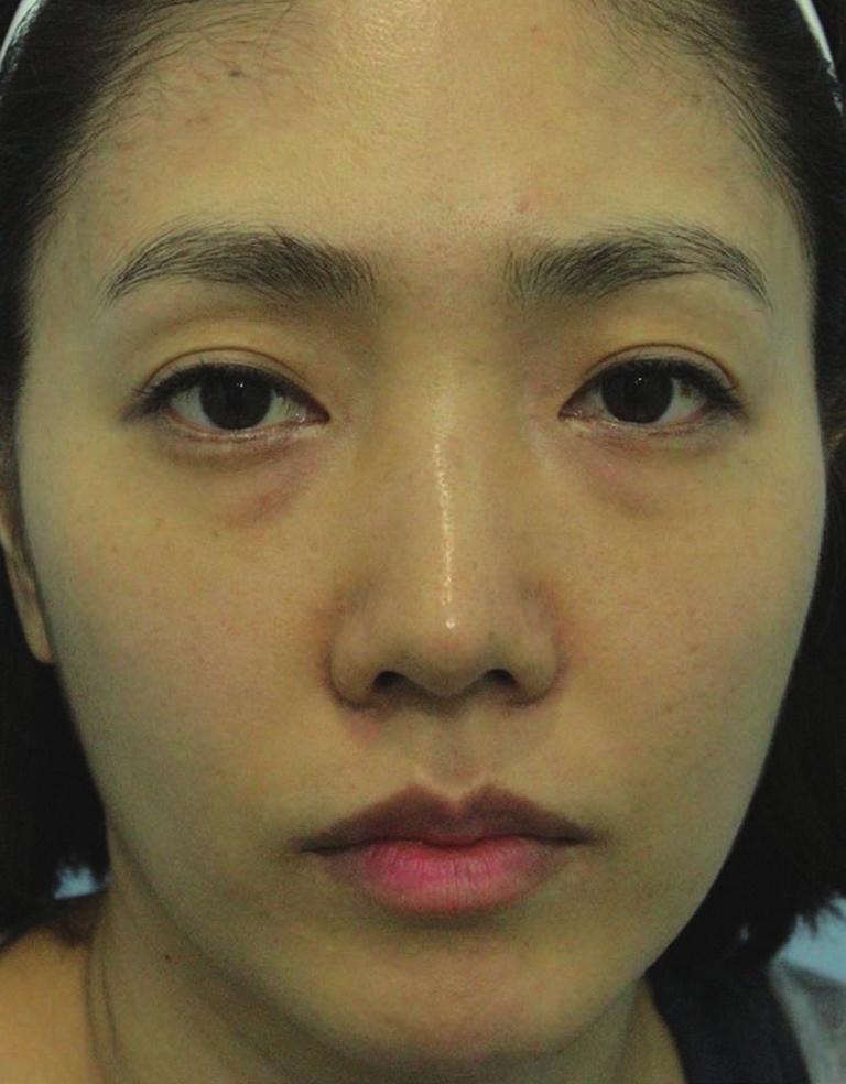 In addition, she was satisfied with the results of this treatment in improvement of skin surface roughness and brightness (4 point; satisfied) (Fig. 3).