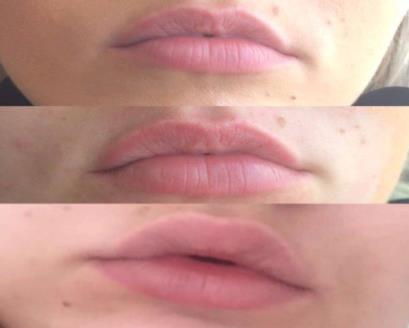 Derma Pen Collagen Lip Plump (Training for this treatment is