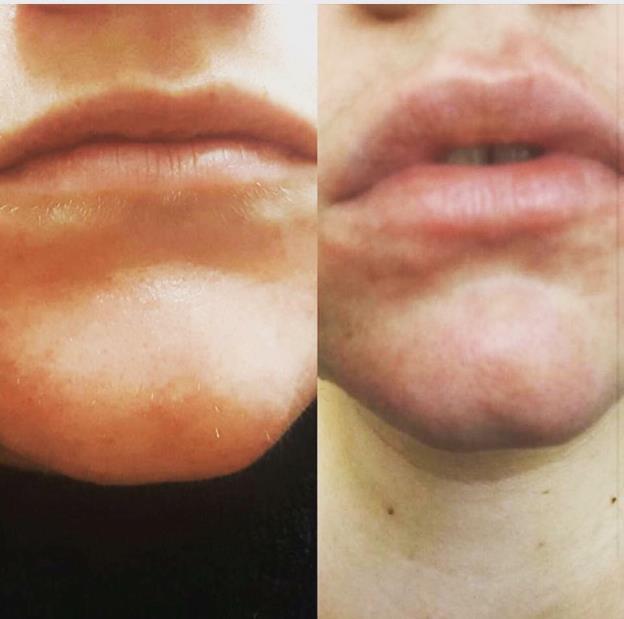 Derma Lip Plump - This treatment is included in the derma pen