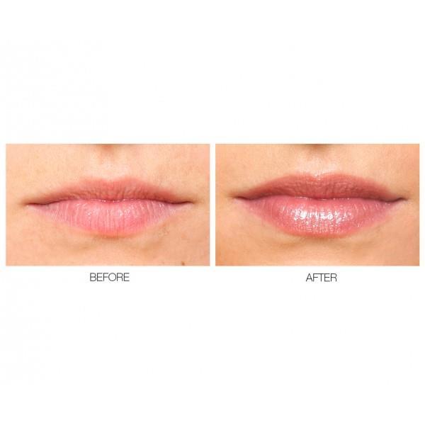 We use a collagen lip plump to infuse the lips, microneedling