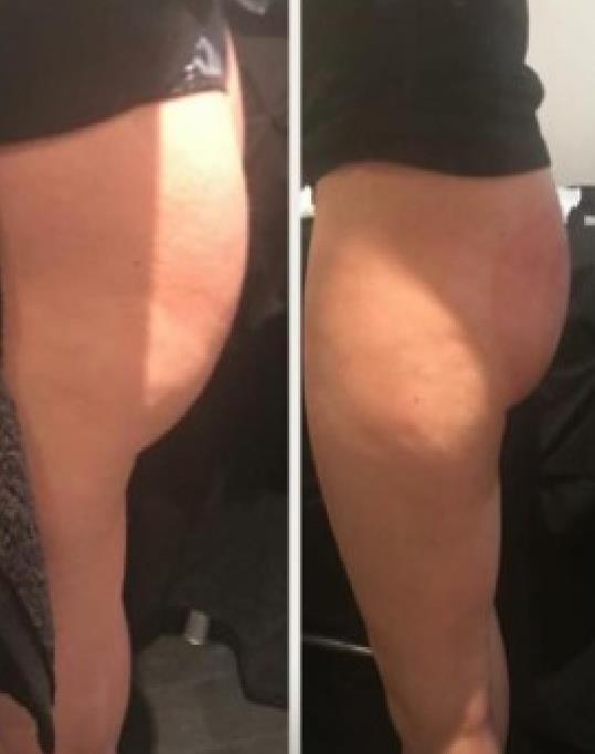Enhance What clients can expect? Most clients see results from their first treatment but this will only last up to 7 days. It is ideal for using in combination with exercise on the bum.