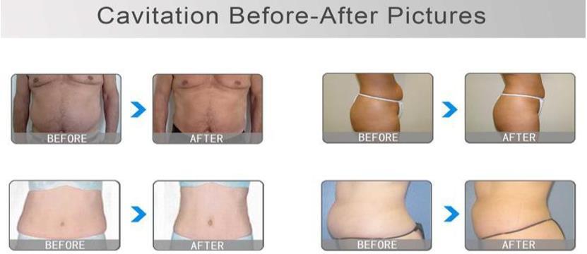 Adonis Cavitation and RF Machine One of the latest developments in the treatment of cellulite and fat break down is ultrasound cavitation.