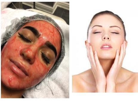 Dragons Blood Facial This course can be completed via video training or at one of our venues throughout the uk. From only 149 for full training and certification!
