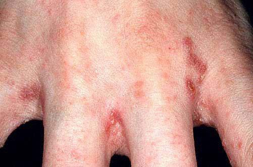 1) Nodular scabies on trunk 2) Scabies on hands Pale burrows described as a greyish line resembling a pencil mark may be present in the skin between the fingers, but are less commonly seen than