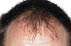 Hair Growth Hair growth typically begins around the 3 rd and 4 th month after your procedure.