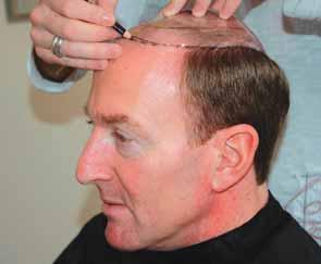 baldness to see that the hairpiece overlaps into the client s hair by at