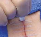 When used in conjunction with sutures, staples or