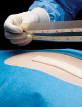 Tensile strength of wound closure with cyanoacrylate glue. Am Surg. 2001;67;1113-1115. 3. Quinn JV: Tissue Adhesives Used in Clinical Medicine. BC Decker Publishing, Hamilton, Canada, 2005. 4.