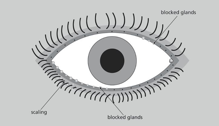 Blepharitis can be uncomfortable, but rarely causes serious eye damage. Why do I get blepharitis? There are two types of blepharitis.
