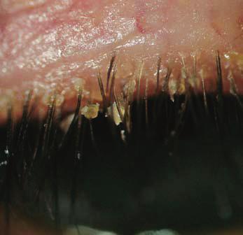 Who is at risk of blepharitis? Blepharitis is more common in people aged over 50, but it can develop at any age.