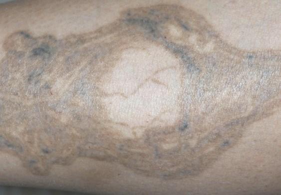 7 Normal skin Tattoo site b c Visit # Fig.
