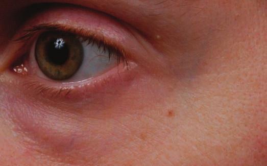 Investigator evaluations of fine and coarse wrinkles in the periocular and perioral areas were assessed at Baseline, Minutes, Month 1, and Month 3.