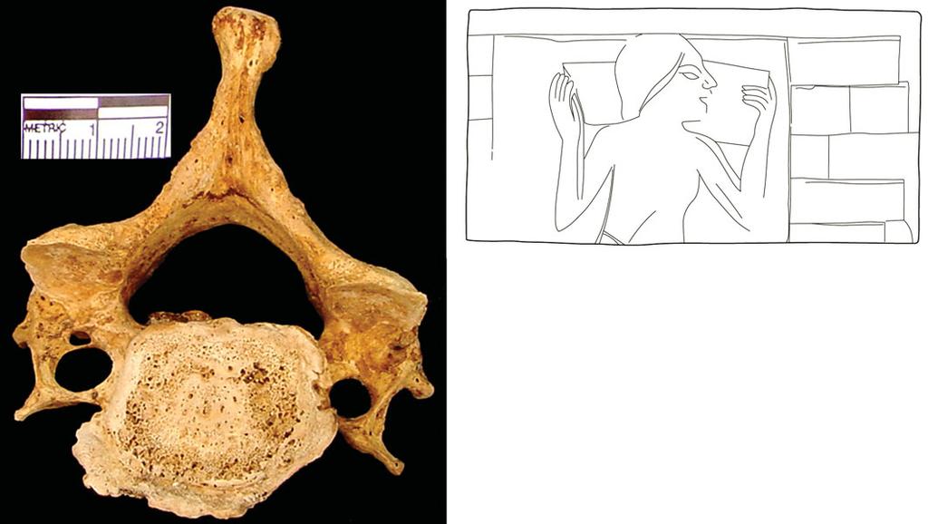 Barry Kemp et al. Research Figure 8. Left) degenerative joint disease as evidenced by porosity or porotic lesions and associated extra bone growth on the inferior aspect of a cervical vertebra.