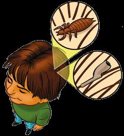How to know if your child has lice? If your child has head lice (pediculosis) don t panic or be embarrassed. Anyone can get head lice regardless of age, social status, or economic background.