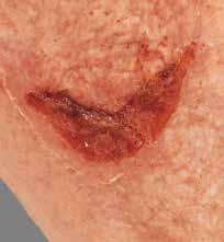 The significance of healthcareacquired skin damage.
