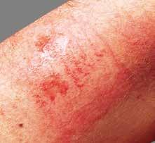including: Medical Adhesive-Related Skin Injury (MARSI) A prevalent but under-recognized complication, MARSI can cause pain, increase the risk of infection and delay healing all of which can reduce a