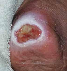 Common forms of MASD include: Peristomal Skin Damage Problem stomas, poor stoma location and