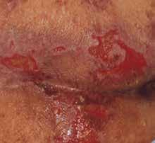 large quantities of drainage, such as venous ulcers or infected wounds.