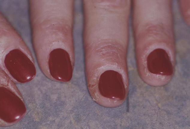 Update on nail cosmetics thus should not be filed flat as this can result in severe local plate thinning and subsequent splitting.