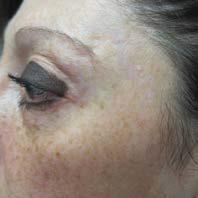 Pigmentation -- Scarring -- Acne scarring --