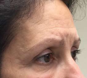 Endoscopic Brow Lift Gravity is a major contributor to the appearance of aging of the face and neck.