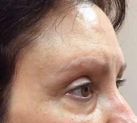 In the upper face (forehead, brows and temples), sagging will lower the brows and deepen crows feet wrinkles in the temple area.