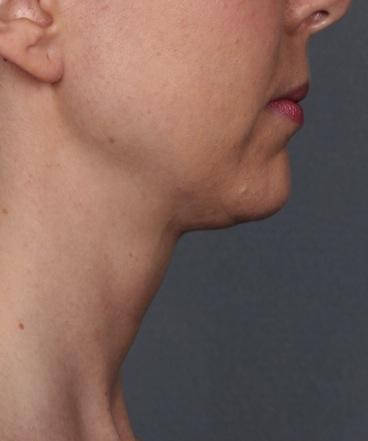 ATX- 101 Changing the Face of Facial Aesthe5cs 35- year old subject with a 1- grade