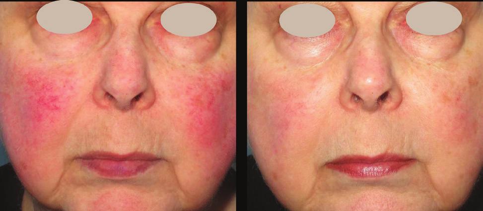 A trusted path to superior outcomes Before After Rosacea treatment with IPL Courtesy of