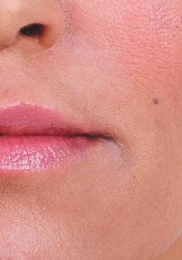 were Botox; formerly knows as botulinum toxin type A and dermal fillers injections, laser hair reduction, chemical peels,