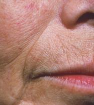 A B C Figure 5. A, Pretreatment views of left and right nasolabial folds in a 66-year-old Asian woman.