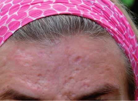 ACNE SCARRING BEFORE