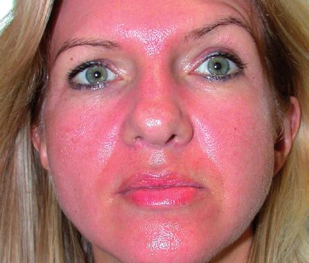 GD SKIN REJUVENATION AFTER PROCEDURE SKINCARE Immediately after your GD Skin Rejuvenation procedure you will look as though you have moderate sunburn and your skin may feel warm and tighter than