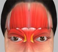 Corrugator muscles cause vertical lines to develop between the eyebrows c.