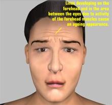The Problem The forehead-eyebrow area is probably the most important single feature in facial expression. When the brow is contracted and depressed medially, an angry threatening look results.