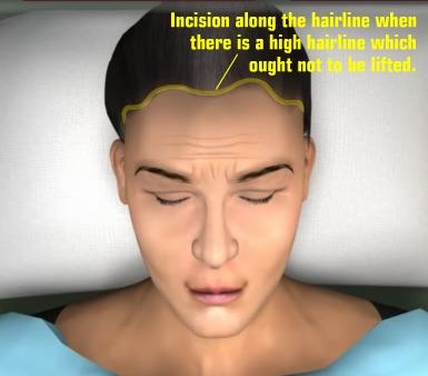 Unit 3: Obviously the hairline is moved backwards a little with this procedure (usually 1-2cm) and it may not be a suitable procedure if you already have a high hairline or receding hair. (Refer fig.