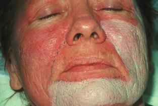 During the application of superficial peeling agents, there may be mild stinging followed by a level I frosting, defined as the appearance of erythema and streaky whitening on the surface (Fig. 1.