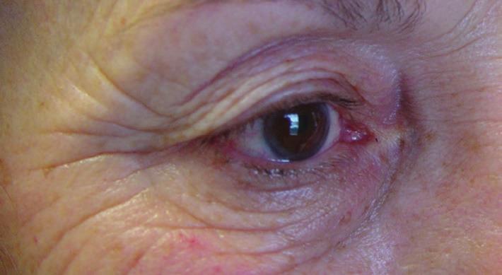 BLEPHAROPLASTY Blepharoplasty surgery involves the removal or redistribution of eyelid tissue.