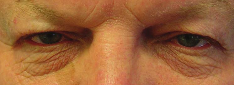ASSOCIATED CONDITIONS Ptosis Some patients may have pre-existing ptosis (low eyelid position) of their upper lids, and this should be corrected at the time of blepharoplasty surgery.