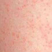 of the body, particularly the outer-upper arms and thighs. Keratosis pilaris is often described in association with other dry skin conditions.