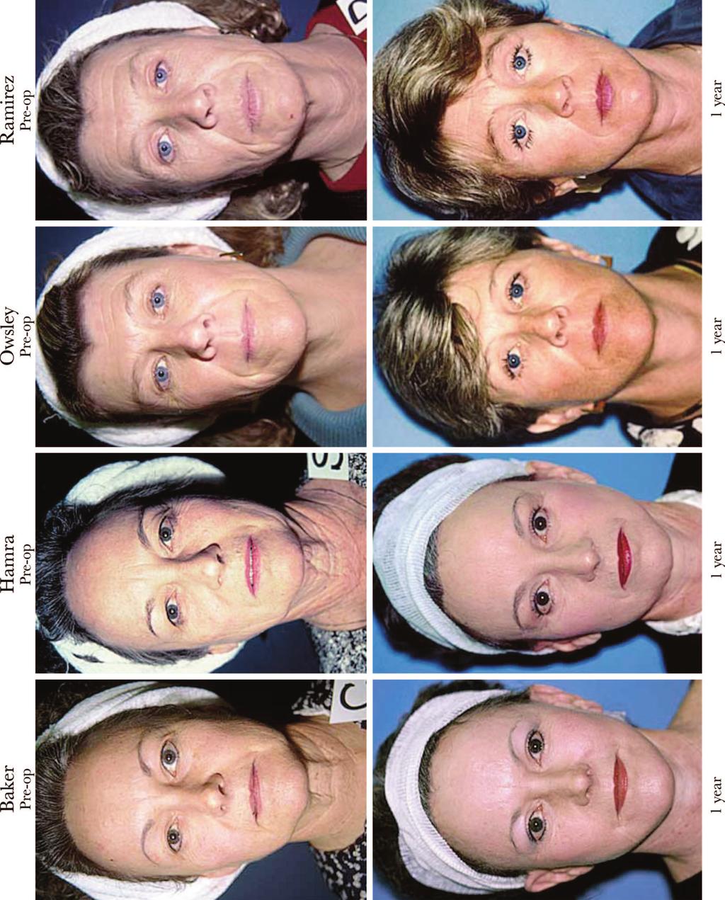 Plastic and Reconstructive Surgery March 2009 Fig. 1. Four patients.